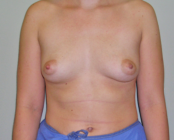 Breast Augmentation Before & After Patient #1709