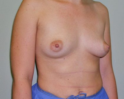 Breast Augmentation Before & After Patient #1709