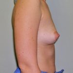 Breast Augmentation Before & After Patient #1709