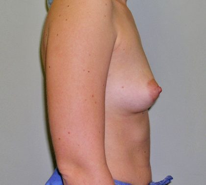 Breast Augmentation Before & After Patient #1709