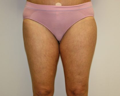 Thigh Lift Before & After Patient #1380