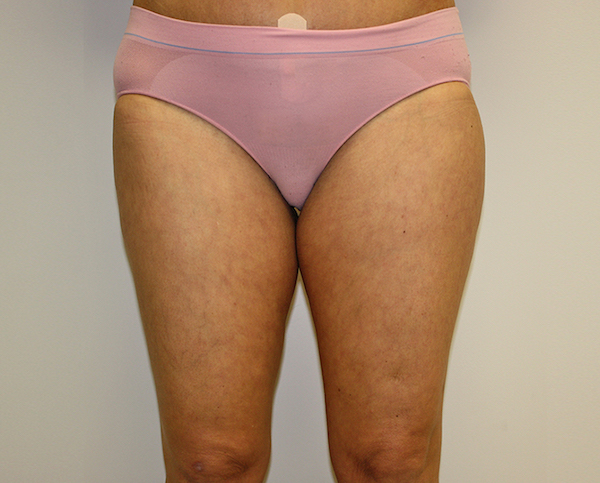 Thigh Lift Before & After Patient #1380