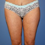 Thigh Lift Before & After Patient #1380