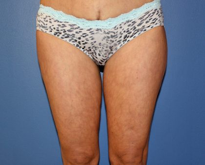 Thigh Lift Before & After Patient #1380