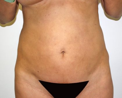 Tummy Tuck Before & After Patient #514