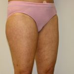 Thigh Lift Before & After Patient #1380