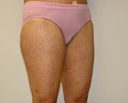 Thigh Lift Before & After Patient #1380