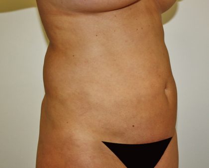 Tummy Tuck Before & After Patient #514