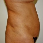 Tummy Tuck Before & After Patient #514