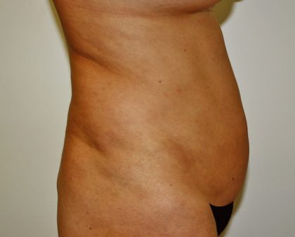 Tummy Tuck Before & After Patient #514