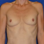 Breast Augmentation Before & After Patient #1723