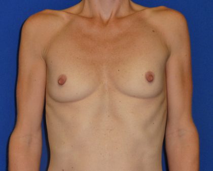Breast Augmentation Before & After Patient #1723