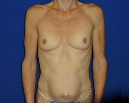 Tummy Tuck Before & After Patient #691