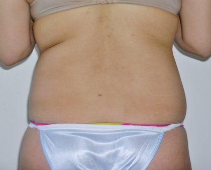 Liposuction Before & After Patient #1117