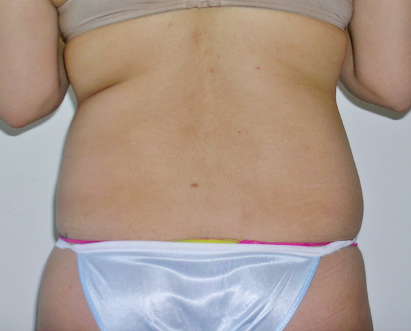 Liposuction Before & After Patient #1117