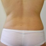 Liposuction Before & After Patient #1117