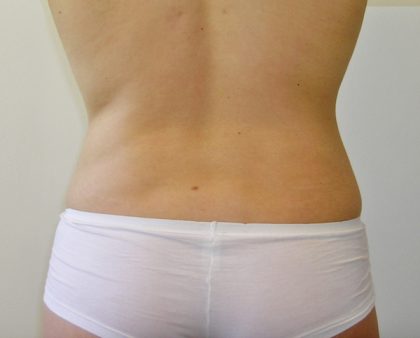 Liposuction Before & After Patient #1117