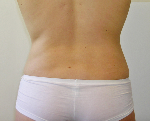 Liposuction Before & After Patient #1117
