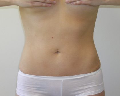 Liposuction Before & After Patient #1110