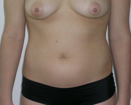 Liposuction Before & After Patient #1110