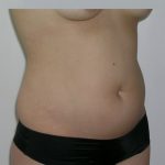 Liposuction Before & After Patient #1110