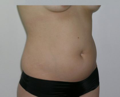 Liposuction Before & After Patient #1110