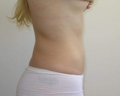 Liposuction Before & After Patient #1110