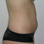 Liposuction Before & After Patient #1110