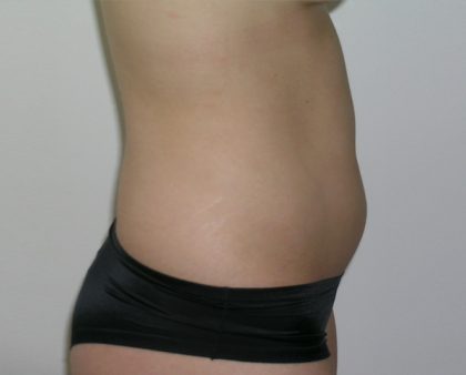 Liposuction Before & After Patient #1110