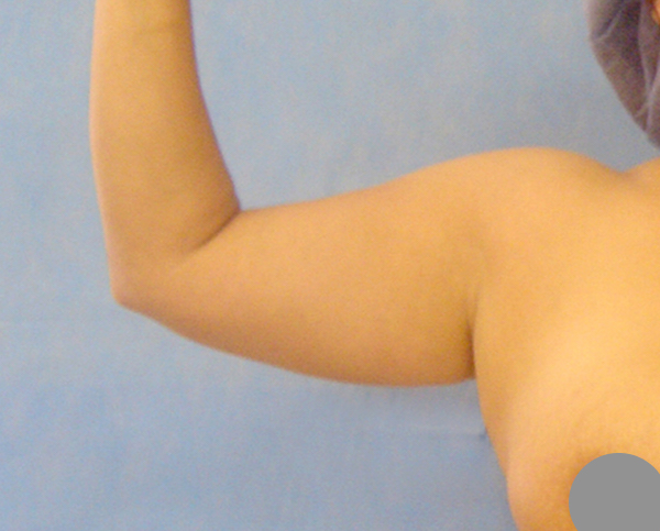 Liposuction Before & After Patient #1139