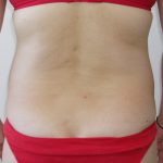 Liposuction Before & After Patient #1158