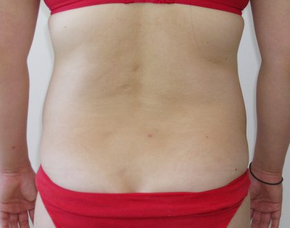 Liposuction Before & After Patient #1158