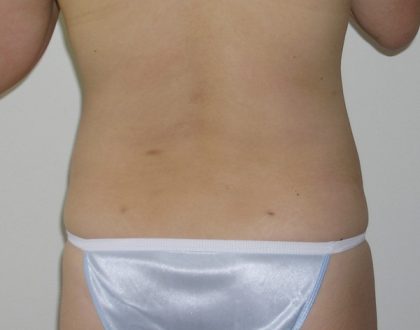 Liposuction Before & After Patient #1158