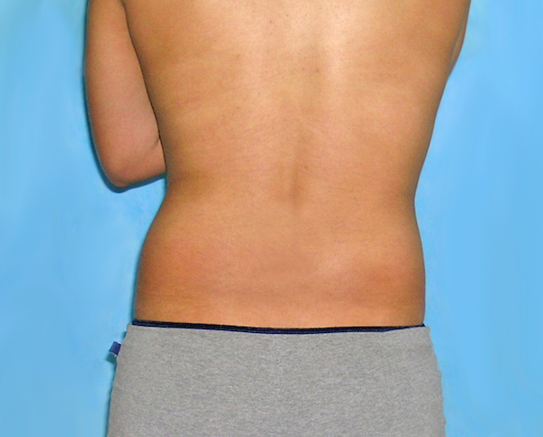Liposuction Before & After Patient #1178
