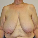 Breast Reduction Before & After Patient #961