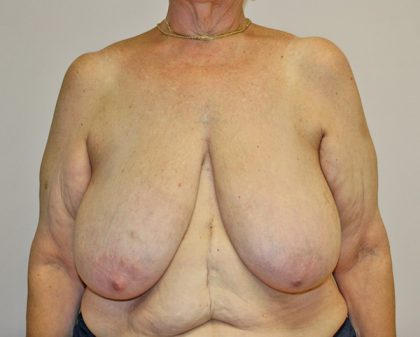 Breast Reduction Before & After Patient #961