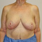 Breast Reduction Before & After Patient #961