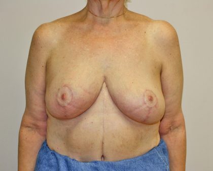 Breast Reduction Before & After Patient #961