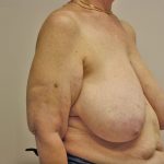 Breast Reduction Before & After Patient #961