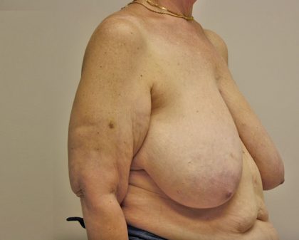 Breast Reduction Before & After Patient #961