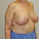 Breast Reduction Before & After Patient #961