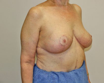 Breast Reduction Before & After Patient #961