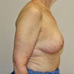 Breast Reduction Before & After Patient #961