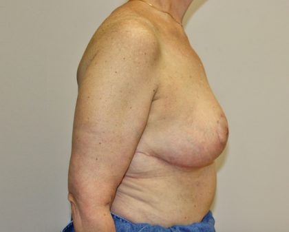 Breast Reduction Before & After Patient #961