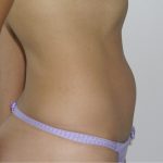 Liposuction Before & After Patient #1208