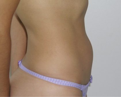 Liposuction Before & After Patient #1208