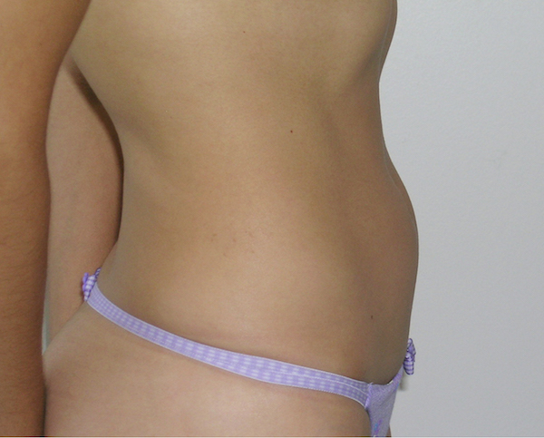 Liposuction Before & After Patient #1208