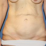 Tummy Tuck Before & After Patient #613