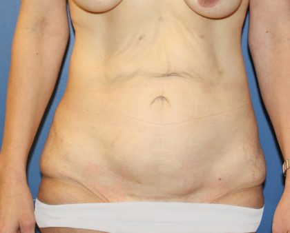 Tummy Tuck Before & After Patient #613