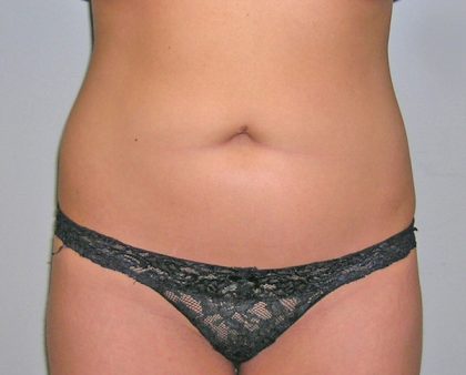 Liposuction Before & After Patient #1226